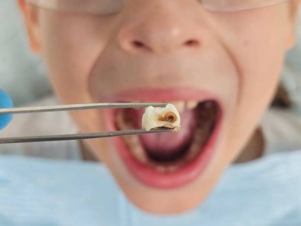 Best Emergency Wisdom Teeth Removal in Millbrook, AL